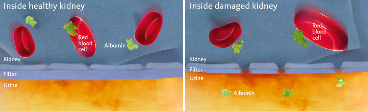 [.PL-pl Poland (polish)] •	Schematic and simplified view of a healthy and a damaged kidney membrane with the latter illustrating the cause of albuminuria.