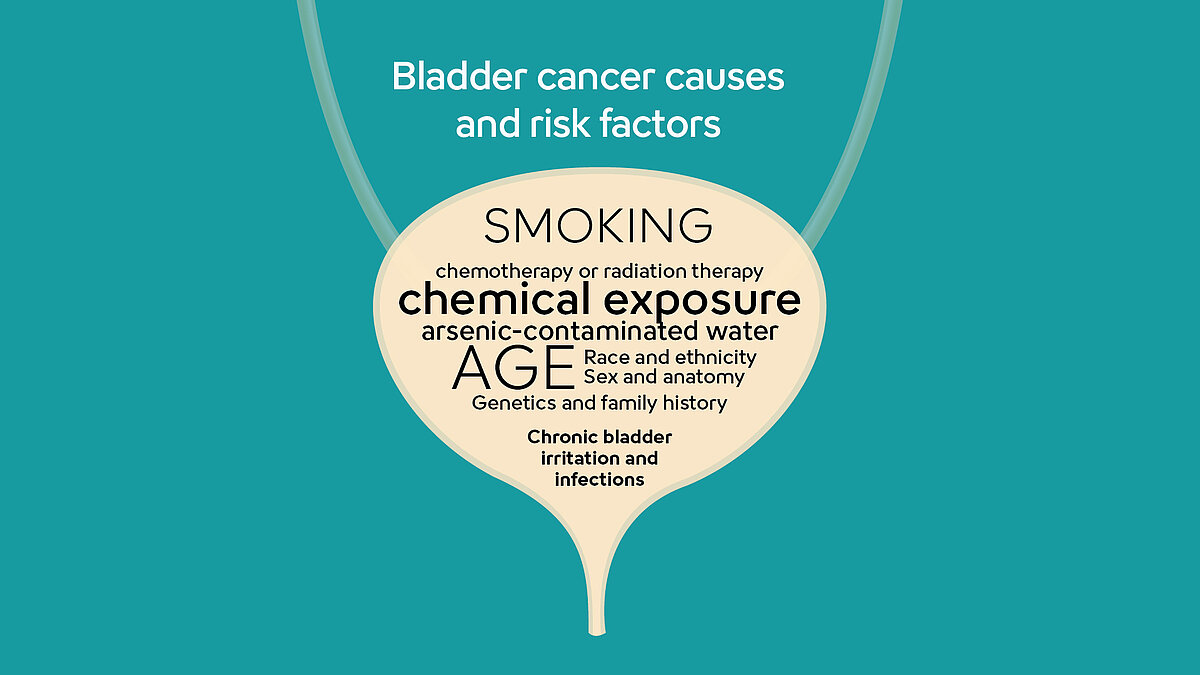 Lista przyczyn i czynników ryzyka rozwoju raka pęcherza moczowego, przy czym najważniejszymi czynnikami ryzyka są wiek i palenie tytoniu  