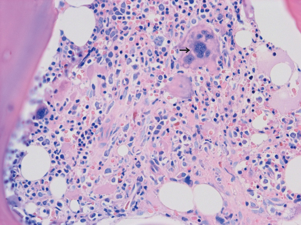 Bone marrow histology showing prefibrotic stage of PMF